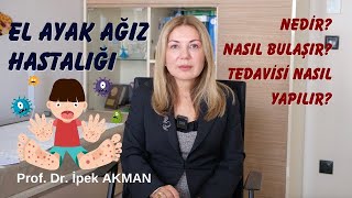 Koksaki Virüsü Neden Oluyor! El Ayak Ağız Hastalığı