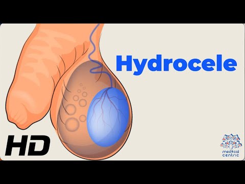Dealing with Hydrocele: Understanding the Condition and How to Manage It