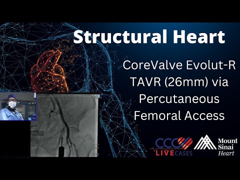 CoreValve Evolut-R TAVR (26mm) via Percutaneous Femoral Access Structural Heart - April 2016 Webcast