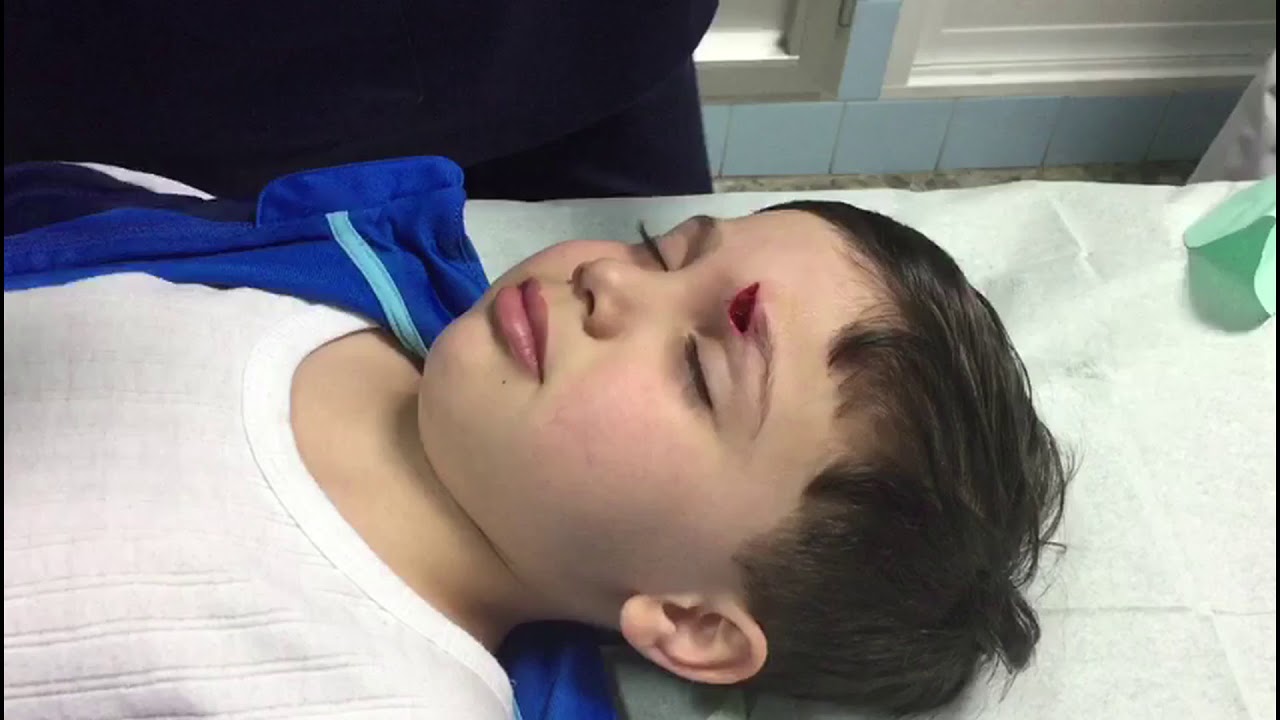 SUTURA ESTÉTICA EN CARA A UN NIÑO DE 4 AÑOS