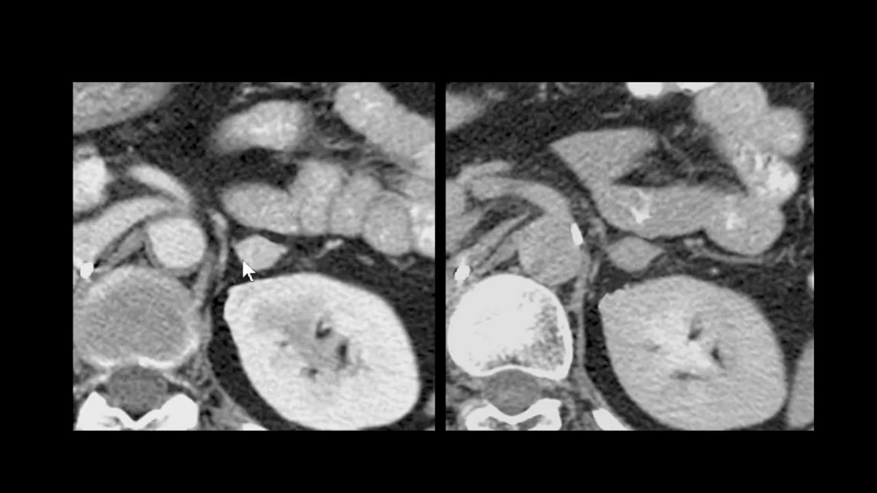 METÁSTASE IMITANDO ADENOMA ADRENAL