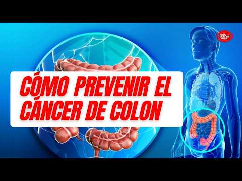 Cómo prevenir el cáncer de colon