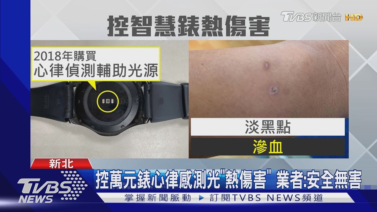 嚇！戴智慧錶「手腕黑斑、滲血」　醫：輕微熱傷害