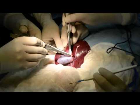 Open Cholecystectomy Video