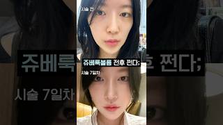 광대 축소 시키고 매끈 얼굴라인 만드는 법