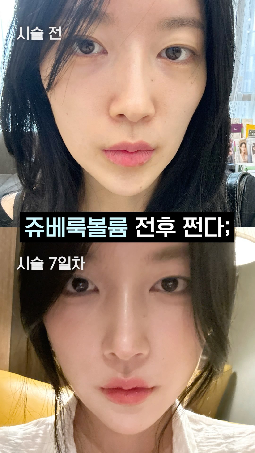 광대 축소 시키고 매끈 얼굴라인 만드는 법