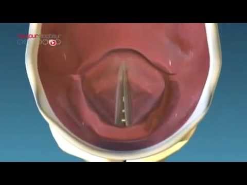 Le larynx 6   les cordes vocales