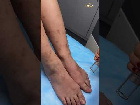 Dark Spots Treatment in Poipet