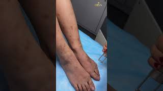 Dark Spots on Legs