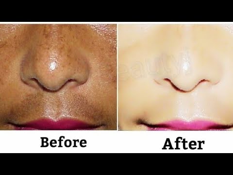 Remove Face Pigmentation , Dark Spots , Brown Spots 100% effective || How to remove pigmentation