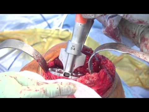 Total Knee Arthroplasty 