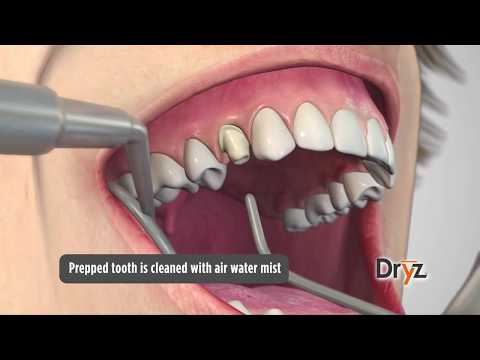 Dryz Gingival Retraction Paste Product Video