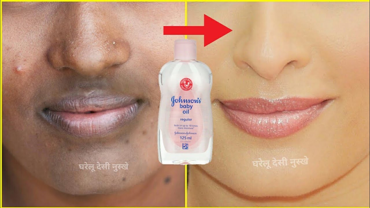 ये सिर्फ 5 मिनट में चेहरे के दाग धब्बे गायब करके इतना गोरा कर देगा की लोग देखते रह जाएंगेAcne,Pimple