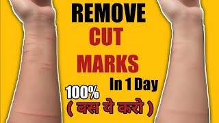How To Remove CUT MARKS From Hand 100% ( Homemade Natural Remedy ) | Remove Scars At Home