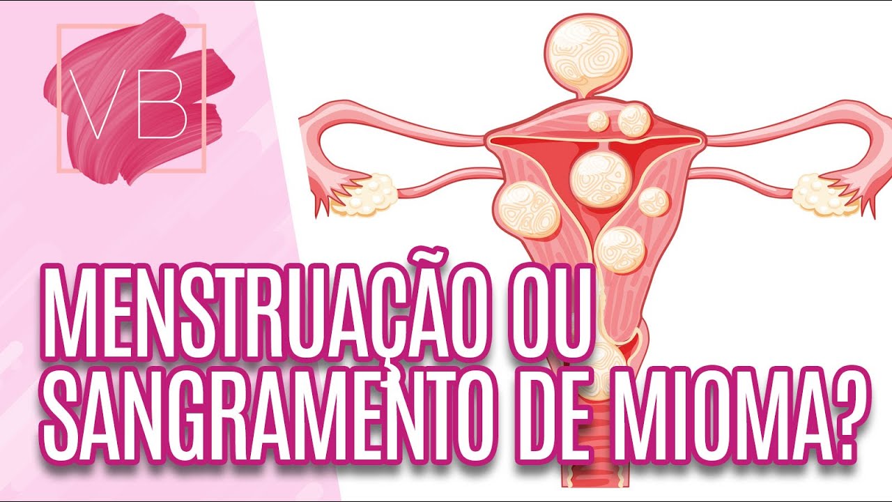 Diferença entre MENSTRUAÇÃO e SANGRAMENTO DE MIOMA - Você Bonita (28/09/2023)