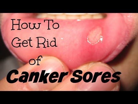 Malakas na gamot laban sa halamang-singaw kuko sa paa review Kung paano gamitin ang hardin Var na may kuko halamang-singaw