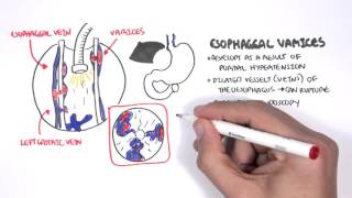 Upper GI Bleed Causes- Overview