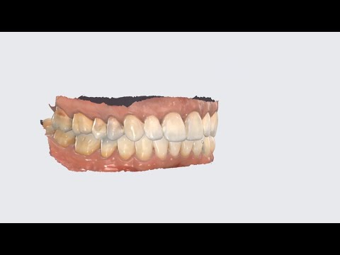 Dental intra-oral scan in 40s
