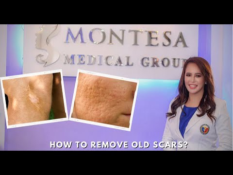 HOW TO REMOVE OLD LEG SCARS? Laser Scar Removal with Golden Canedo