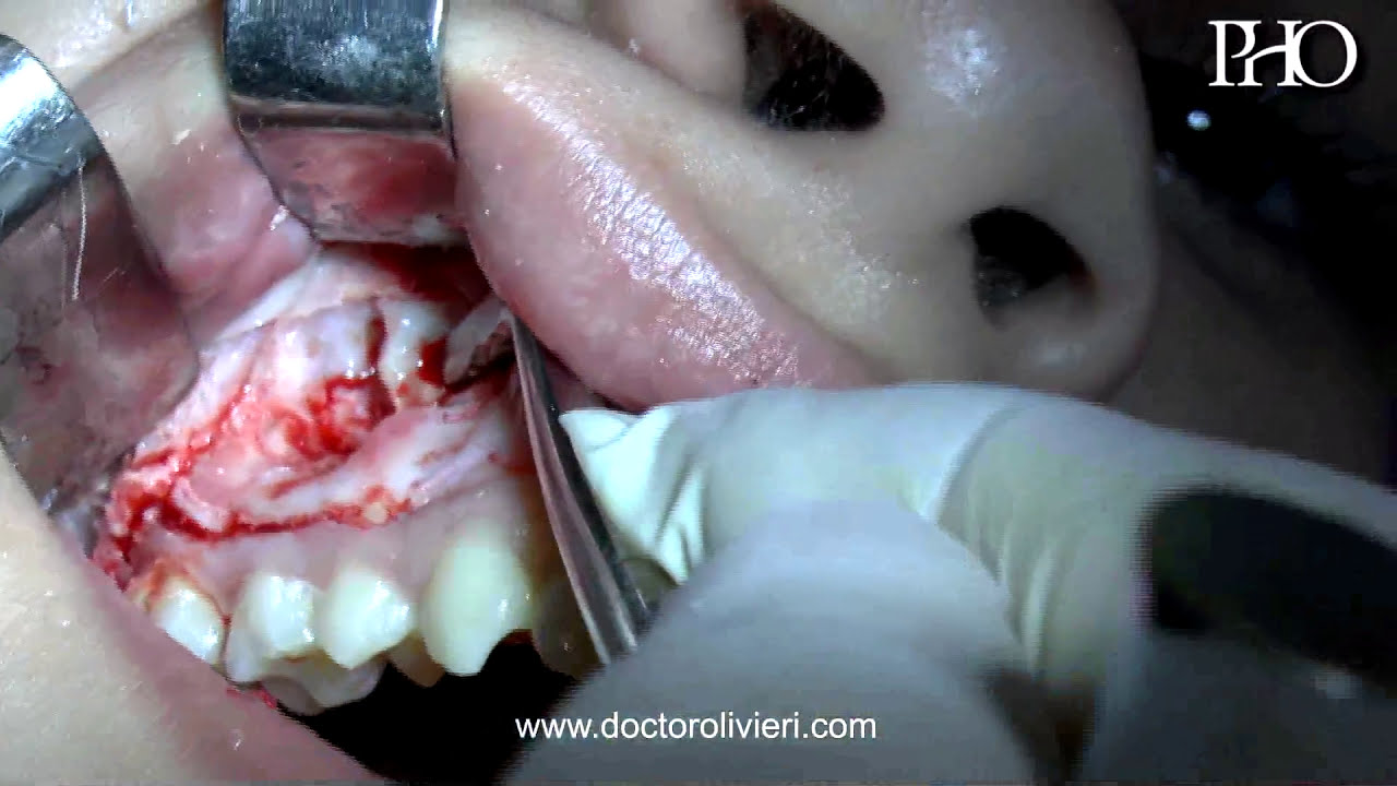 Extracción de dientes supernumerarios en maxilar superior