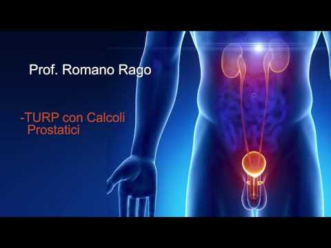 Erezione dopo la rimozione del cancro alla prostata Metodi e regimi prostatite