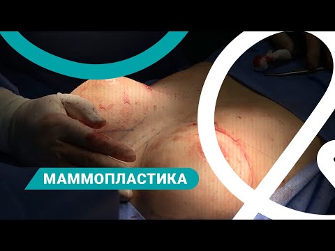 Мамопластика - відео