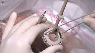 Magnetic Resonance Image guided Brachytherapy for Cancer of the Cervix
