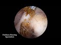 Thick Hair Mass Stuck In Ear Canal Removed