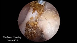 Thick hair mass stuck in ear canal removed