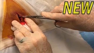 Numbers&#39; Infected Back Cyst Procedure!  BRAND NEW
