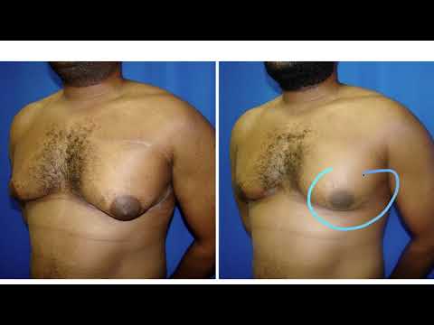 Can Lipo Alone Fix Gynecomastia? 4 Cases