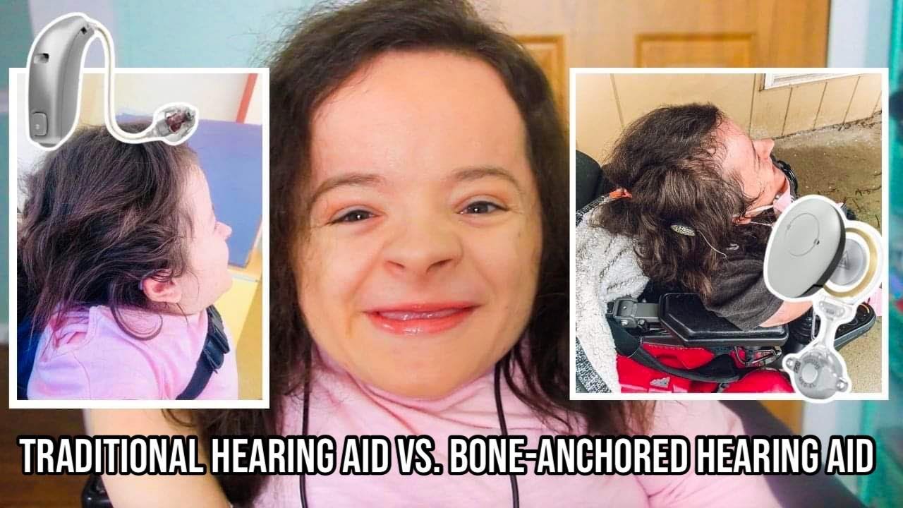 THE DIFFERENCES BETWEEN A BONE-ANCHORED HEARING AID AND TRADITIONAL HEARING AID