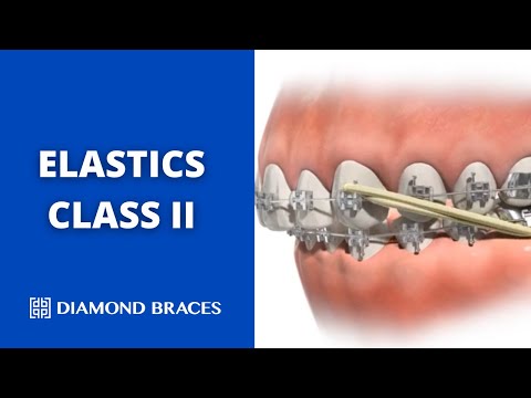 Elastics Class II: Visual Guide to Function and Results