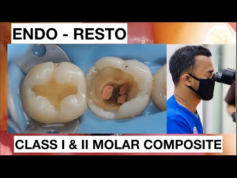 Step by Step Layering Composite Class II Lower Molar Endo - Resto