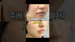 팔자주름 지우개, 쥬베룩 볼륨