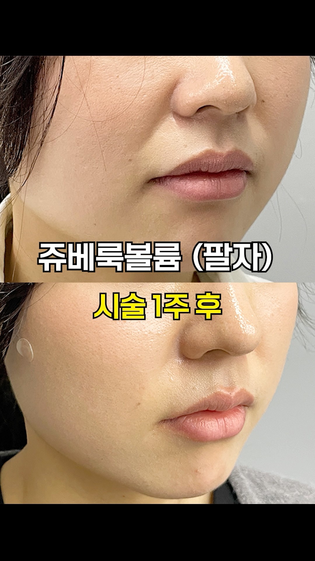 팔자주름 지우개, 쥬베룩 볼륨