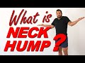 What The HECK Is NECK HUMP
