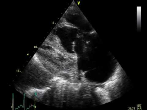 comment traiter embolie pulmonaire