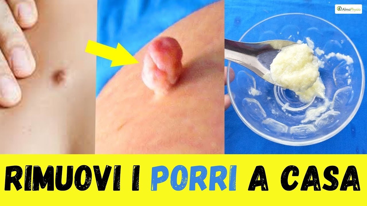 Watch Now Rimedi naturali per rimuovere i PORRI sulla pelle Rimedi naturali per rimuovere i PORRI sulla pelle