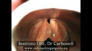 Edema de Reincke, diagnóstico y tratamiento.