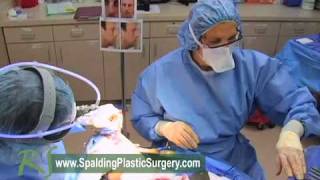 Rhinoplasty los angeles patient experience