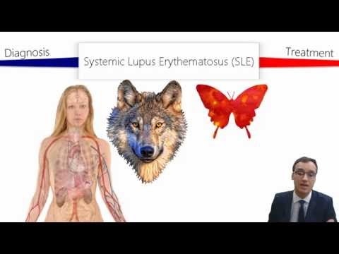 Lupus (SLE) tünetei és kezelése - HáziPatika