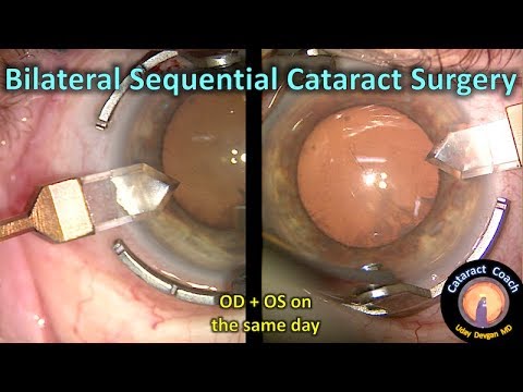 Should we do bilateral sequential same-day cataract surgery?