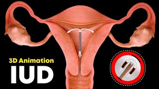 How IUD Is Inserted ? (3D Animation)