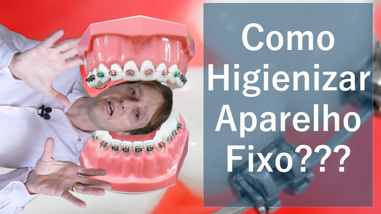 Como Higienizar Aparelho Ortodôntico Fixo em 3 Passos Simples