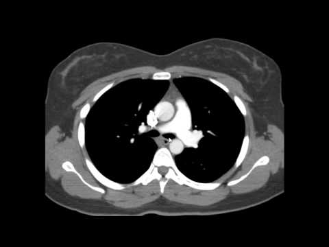 Chest CT scan: Anatomy