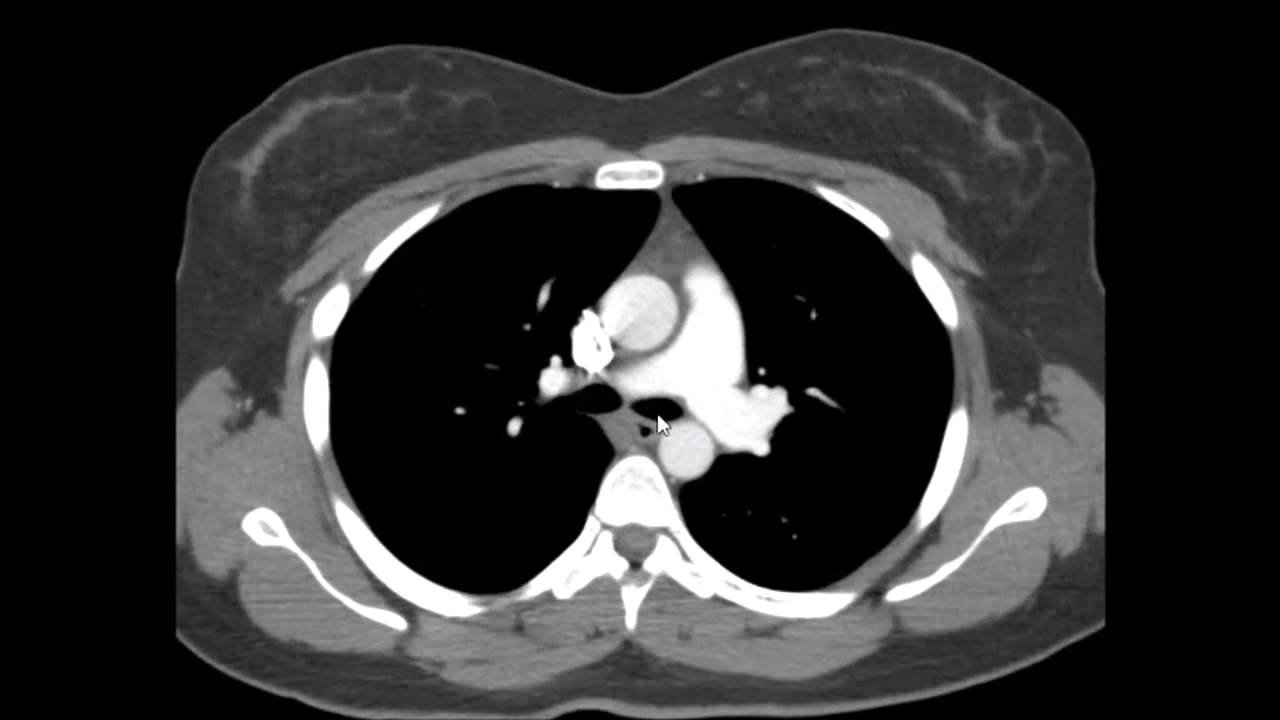 TC do Tórax: Anatomia