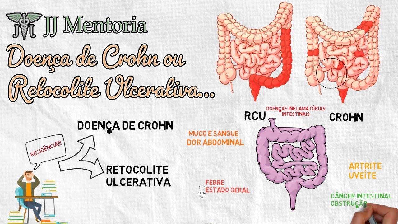 Doença de Crohn ou Retocolite Ulcerativa… eis a questão!