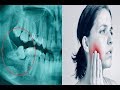 Extraer muela con dolor puede ser de riesgo mortal Extraer muela con dolor puede ser de riesgo mortal