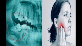 Extracting a tooth with pain can be life-threatening.